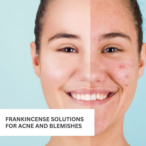 Frankincense Solutions for Acne and Blemishes