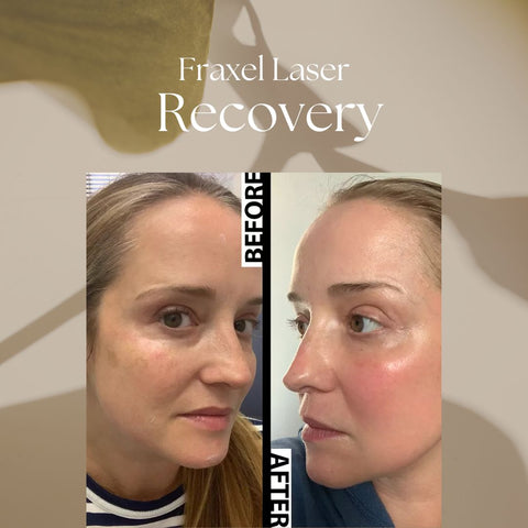 Fraxel Laser Recovery