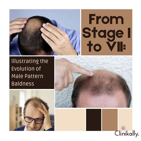 From Stage I to VII: Illustrating the Evolution of Male Pattern Baldness