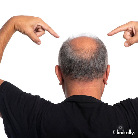 Genetic factors and male pattern baldness