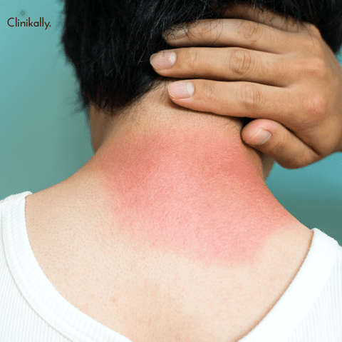 Sunburn Vs. Sun Poisoning: An Overview of the Differences and Symptoms