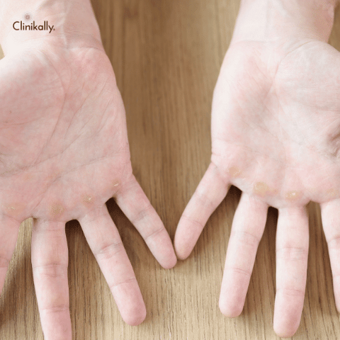 What is a Callus?