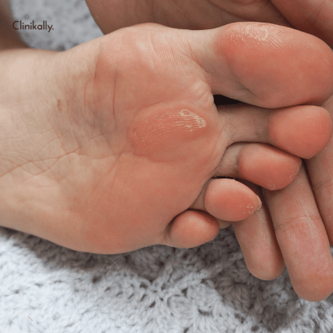 What is a Callus?