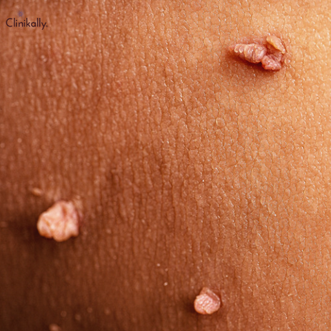 Skin Tags and Their Causes