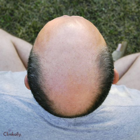 androgenetic alopecia 