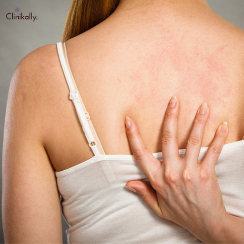 What can trigger hives rash?