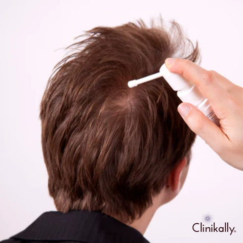 How to apply topical finasteride spray