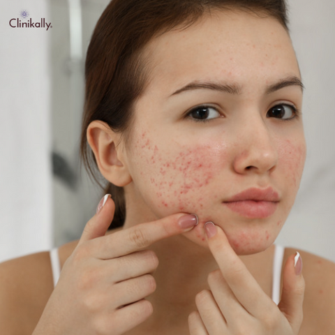 Acne Vulgaris: Causes, Treatment & Home Remedies 