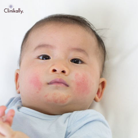 What causes baby acne?