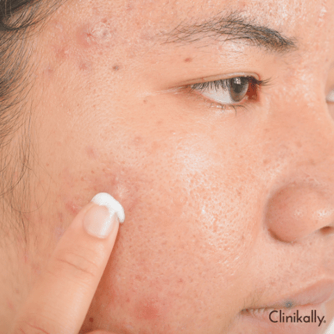 Doxycycline for Acne: A Comprehensive Guide