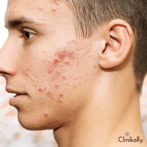 faces with acne vulgaris