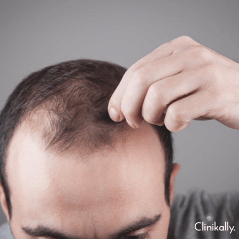 androgenetic alopecia 