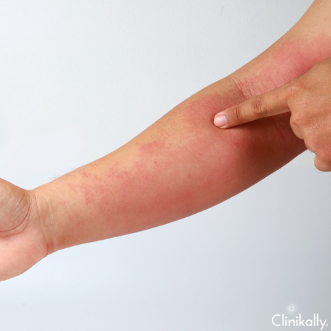 What can trigger hives rash?