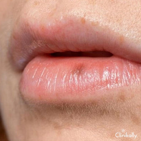 Impact of UV radiation on lip pigmentation