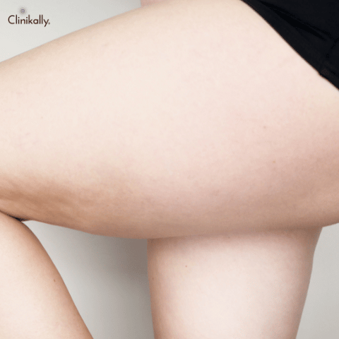 Inner Thigh Acne