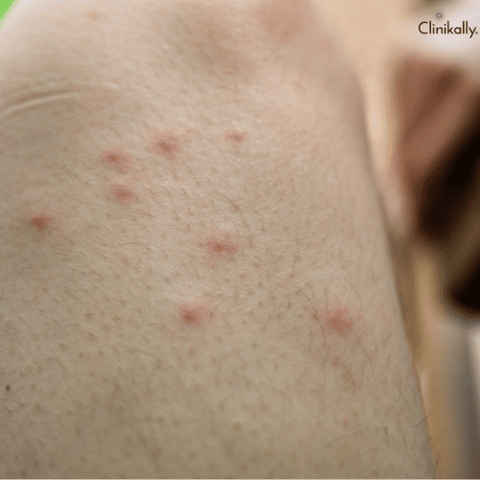 Natural Ways To Get Rid Of Inner Thigh Rashes 