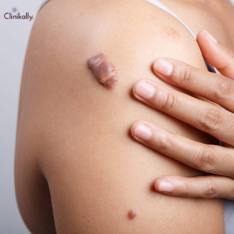Keloids: Recommended Treatments to Get Rid of These Unsightly Scars