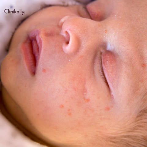 Can babies get acne?