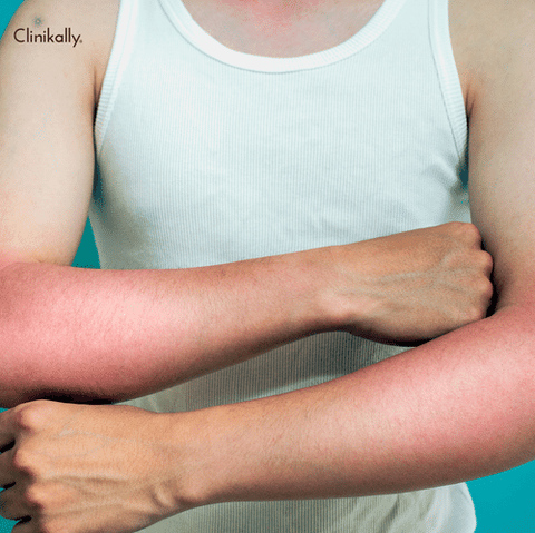 Sunburn Vs. Sun Poisoning: An Overview of the Differences and Symptoms