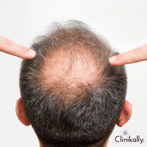 Can you replace Redensyl with Minoxidil?