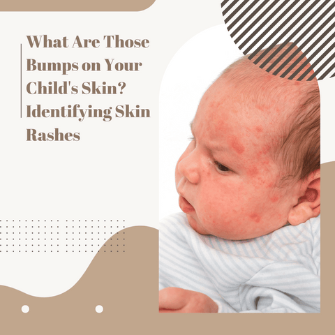 What Are Those Bumps on Your Child's Skin? Identifying Skin Rashes
