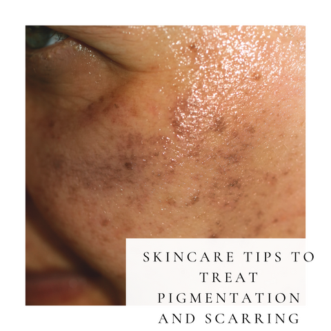 Skincare tips to treat pigmentation and scarring
