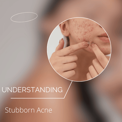 Understanding Stubborn Acne