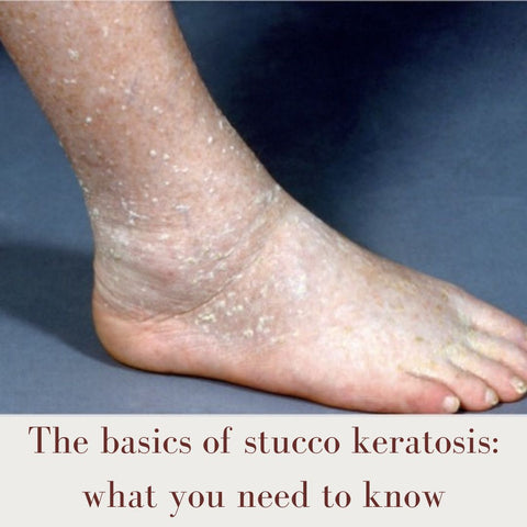 The basics of stucco keratosis: what you need to know
