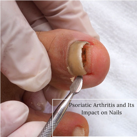 Psoriatic Arthritis and Its Impact on Nails
