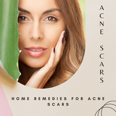 Home remedies for acne scars