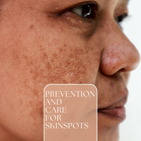 What's The Difference Between Freckles And Sun Spots?: Center Aesthetic &  Dermatology