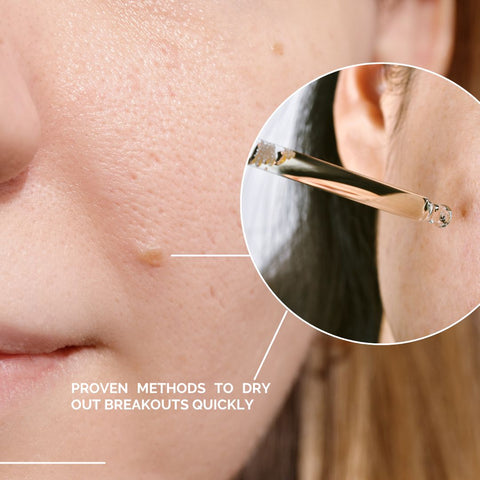 Identifying Effective Acne Treatments