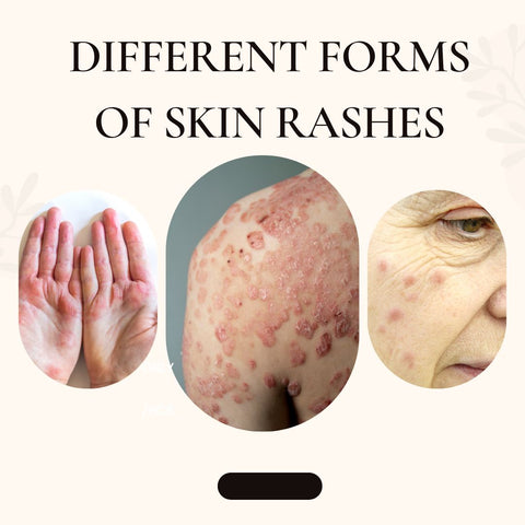 Different forms of skin rashes