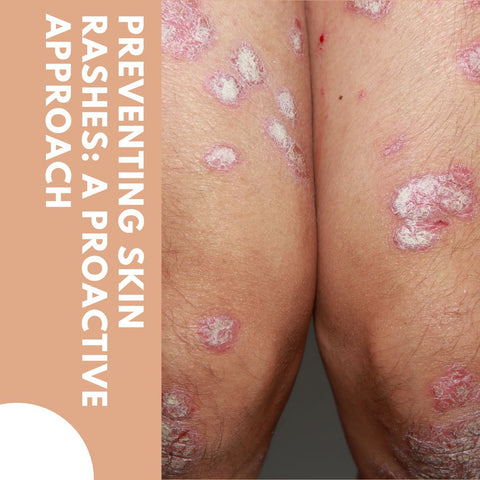 Preventing skin rashes: A proactive approach
