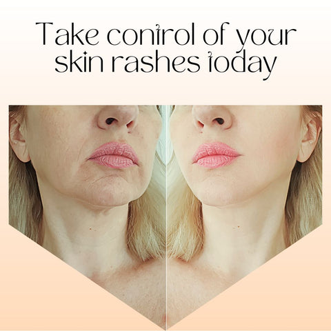 Take control of your skin rashes today