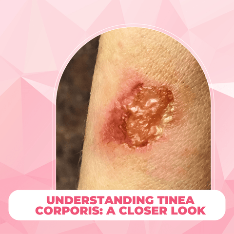 The Secrets of Tinea Corporis and Glowing Skin