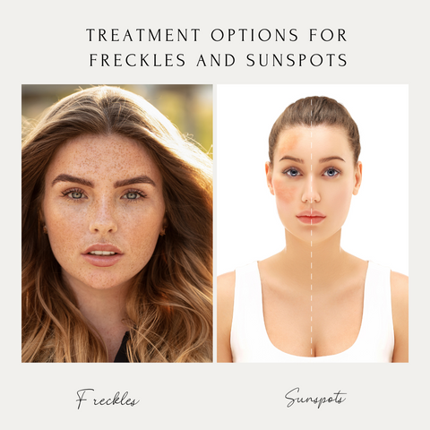 What's The Difference Between Freckles And Sun Spots?: Center Aesthetic &  Dermatology