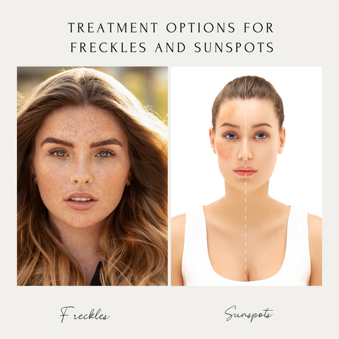 Treatment Options for Freckles and Sunspots