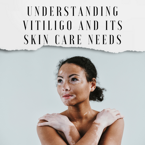 Understanding Vitiligo and Its Skin Care Needs