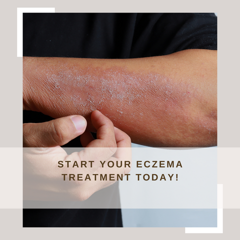 Start your eczema treatment today!