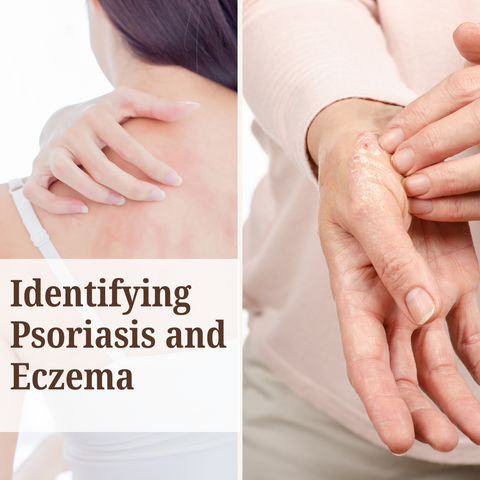 Identifying Psoriasis and Eczema