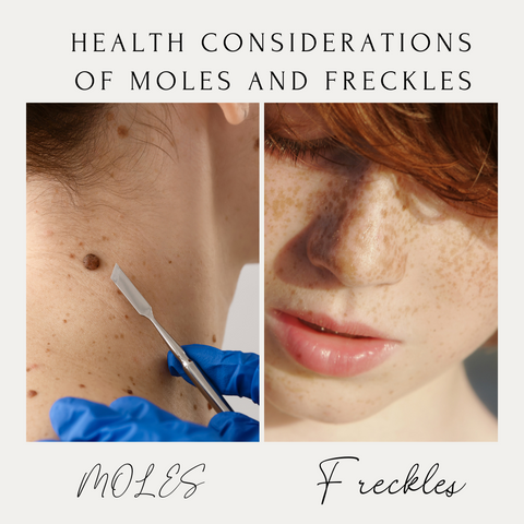 Health Considerations of Moles and Freckles