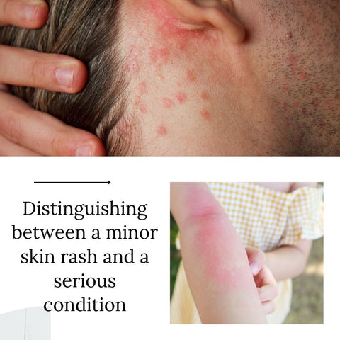 Distinguishing between a minor skin rash and a serious condition