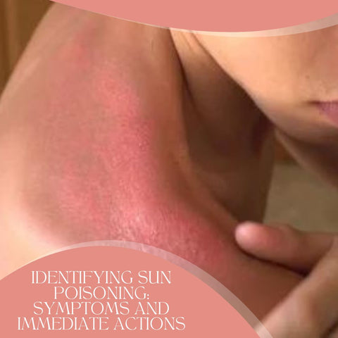 Identifying Sun Poisoning: Symptoms and Immediate Actions