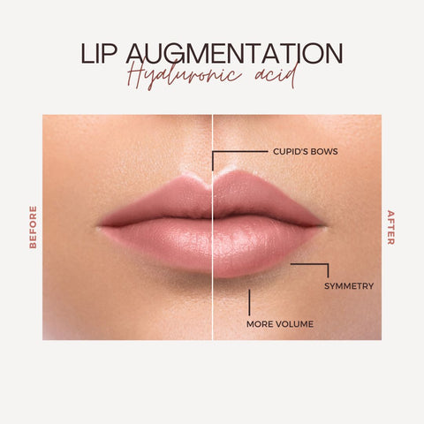 Navigating the Lip Augmentation Procedure
