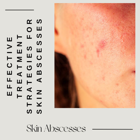 Effective Treatment Strategies for Skin Abscesses