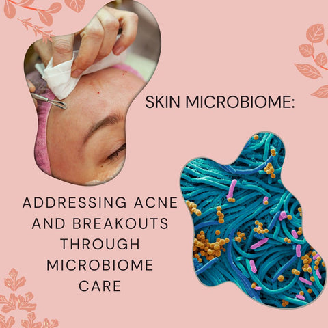 Addressing Acne and Breakouts Through Microbiome Care