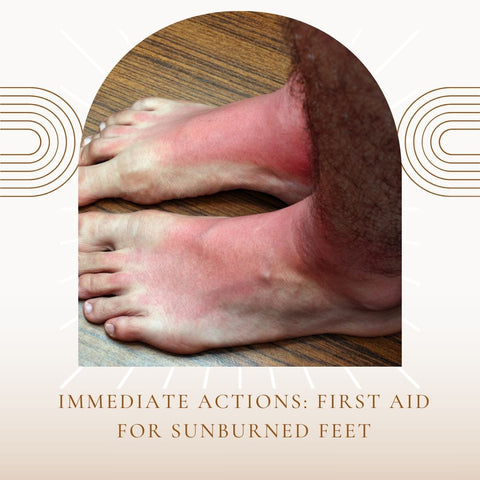 Immediate Actions: First Aid for Sunburned Feet