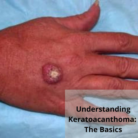 Understanding Keratoacanthoma: The Basics