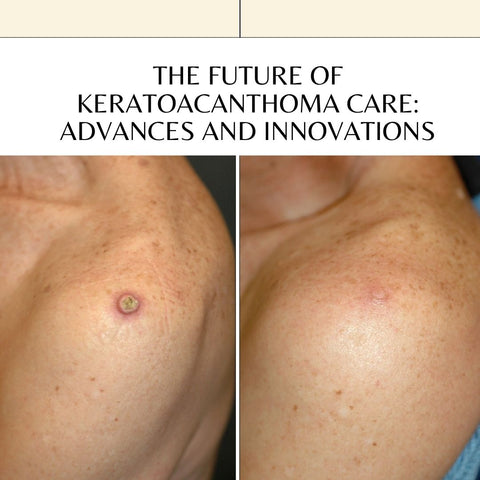 The Future of Keratoacanthoma Care: Advances and Innovations